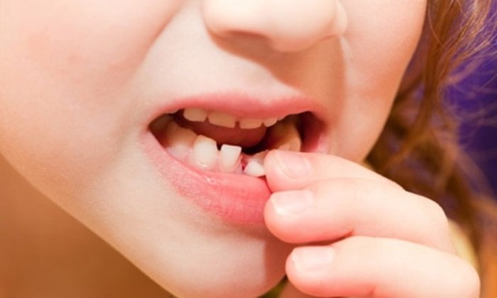 bé 4 tuổi có nhổ răng được không