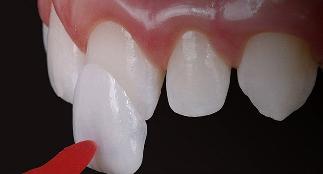 phương pháp phủ sứ răng