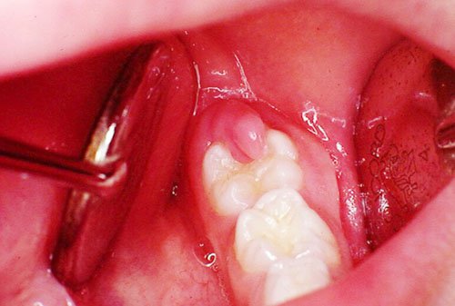 sưng nướu răng trong cùng hàm dưới