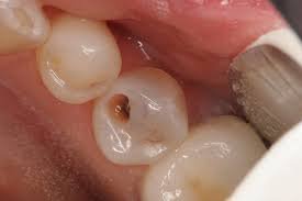 quá trình bị sâu răng