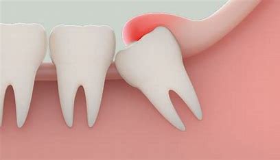 Hình ảnh minh họa cho răng khôn mọc lệch