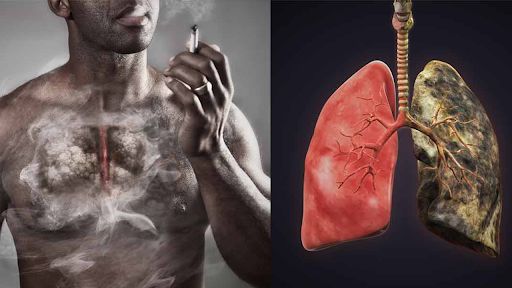 Hút thuốc lá là nguy cơ hàng đầu của COPD