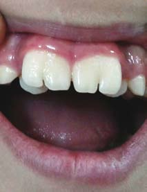 Răng sinh đôi ở bệnh nhân
