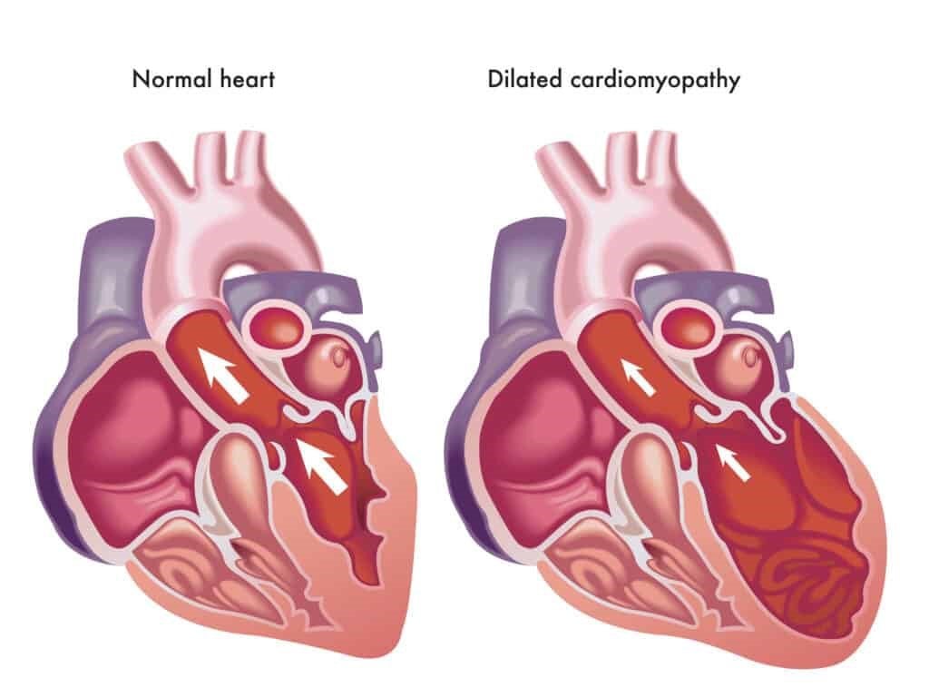 Cơ tim bình thường và cơ tim khi mắc bệnh cơ tim giãn nở