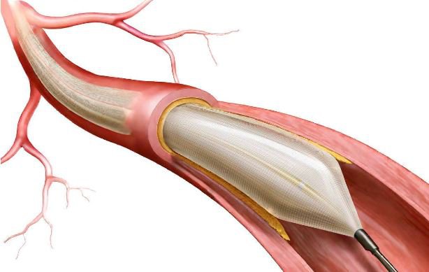 Đặt stent là phương pháp can thiệp động mạch vành qua da