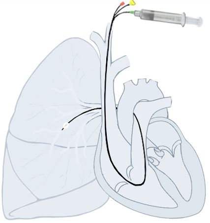 Thông tim và những điều cần biết: Thông tim là một thủ thuật y khoa quan trọng trong chẩn đoán và điều trị các bệnh tim mạch. Nguồn: Wikipia