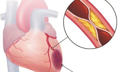 Can people with coronary artery disease eat eggs?