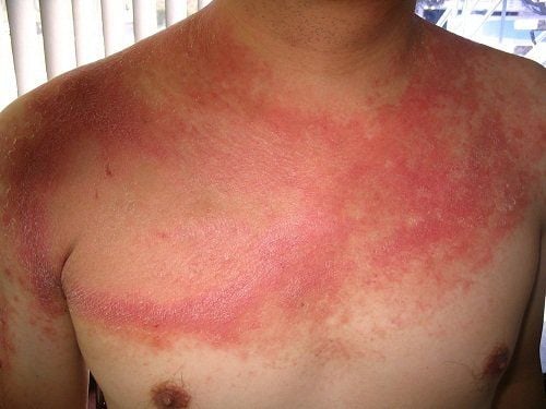 Giải đáp về bệnh Lupus