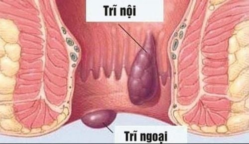 Các loại thực phẩm tốt nhất và tệ nhất dành cho bệnh trĩ