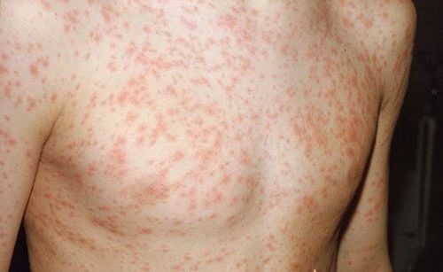 Bệnh Rubella (Sởi Đức) (P2)