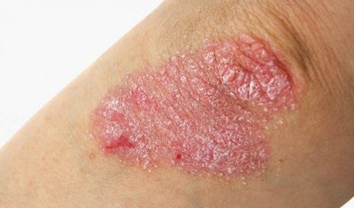 Cách phân biệt vẩy nến và eczema