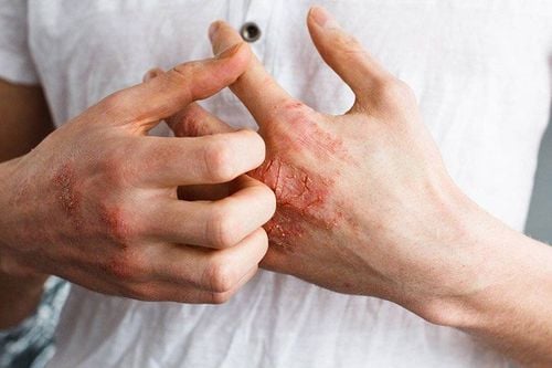 Liệu có thể mắc giang mai và HIV cùng lúc không?