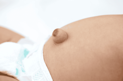 Protruding navel in newborns: Will it resolve on its own or need treatment?