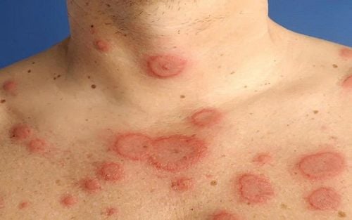 Bệnh Lupus: Nguyên nhân và điều trị