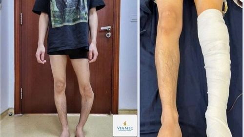 "Straightening" the lower leg for a patient with a foot deformity angle of over 50 degrees