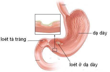 Note to patients with peptic ulcer disease