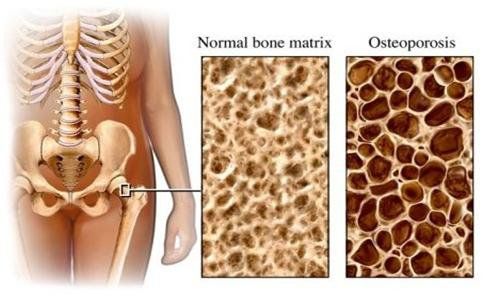 Loãng Xương Nặng: Nguyên Nhân, Triệu Chứng và Giải Pháp Điều Trị Hiệu Quả