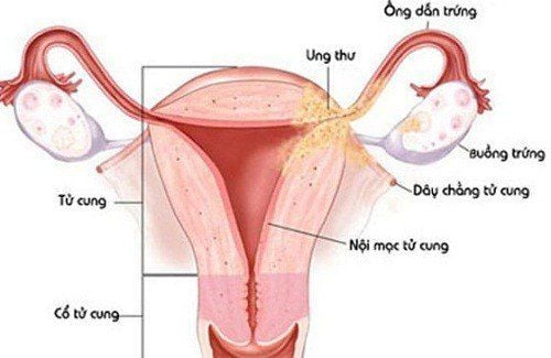 
Dấu hiệu nhận biết viêm phần phụ khá giống so với các bệnh phụ khoa khác
