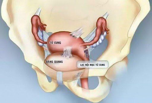 Nang Lạc Nội Mạc Tử Cung: Nguyên Nhân, Triệu Chứng Và Cách Điều Trị Hiệu Quả