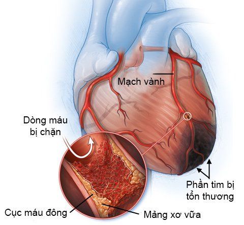 
Nhồi máu cơ tim là biến chứng nghiêm trọng nhất của thiếu máu cơ tim.
