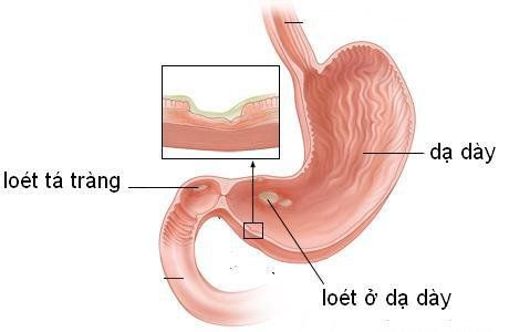 Tìm hiểu về bệnh viêm loét dạ dày - tá tràng