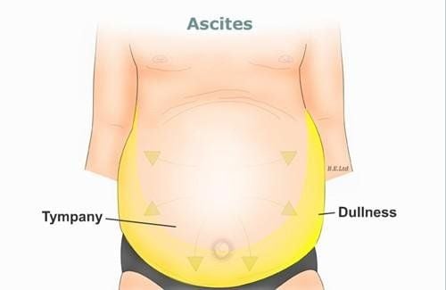 Abdominal sinus aspiration in patients with cirrhosis and ascites