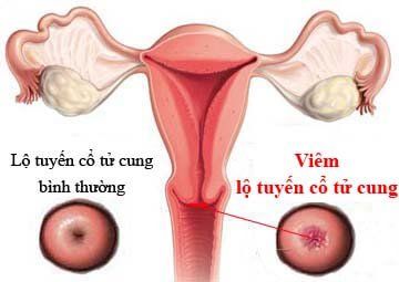 Viêm lộ tuyến cổ tử cung 1cm là nặng hay nhẹ ?