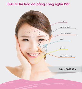 
Vị trí tiêm PRP trên khuôn mặt
