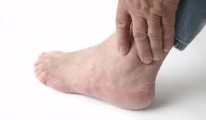 Gout - Symptoms, treatment and prevention