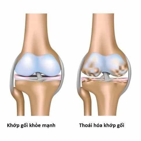 
Hình ảnh thoái hóa khớp gây đau đầu gối
