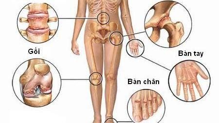 
Bệnh viêm đa khớp ảnh hưởng nhiều khớp cùng một lúc
