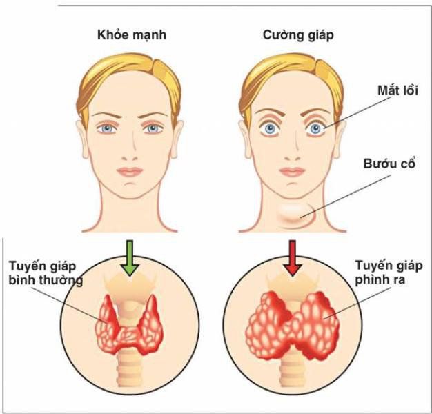 U Cường Giáp Là Gì? Tìm Hiểu Từ A Đến Z Về Tình Trạng Y Tế Này