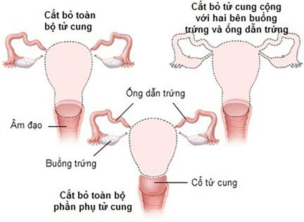 Phương pháp chăm sóc và điều trị tử cung, buồng trứng