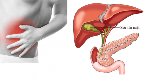 Gallstones - Causes, symptoms and treatment