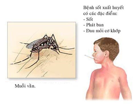 
Dấu hiệu của sốt xuất huyết Dengue là sốt cao, phát ban, đau cơ khớp.
