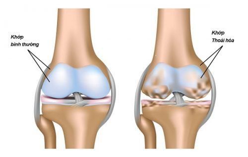 
Thay khớp gối được áp dụng khi bệnh đã ở giai đoạn 3 hoặc 4, không thể điều trị bằng các phương pháp khác
