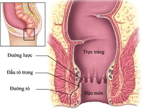 
Rò hậu môn không chỉ gây đau đớn mà còn ảnh hưởng đến cuộc sống sinh hoạt của người bệnh
