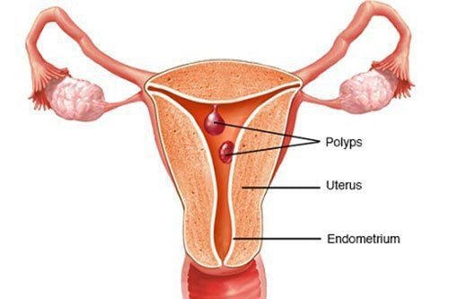 
Polyp cổ tử cung.
