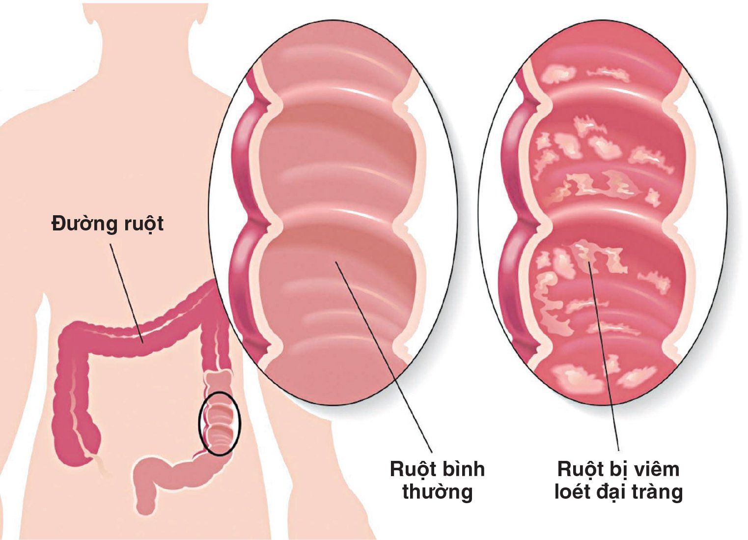 3. Nguyên nhân của hội chứng ruột kích thích