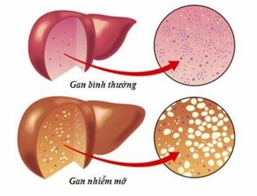 
Mô tả sự khác biệt giữa gan thường và gan nhiễm mỡ.
