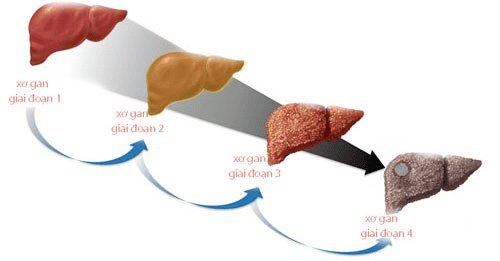 
Các giai đoạn của bệnh xơ gan
