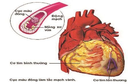 
Chụp động mạch vành cũng có thể được dùng kết hợp với các phương pháp điều trị bệnh mạch vành.
