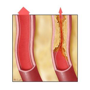 
Các mảng xơ vữa động mạch làm giảm lượng máu tới tim và cần được thay thế
