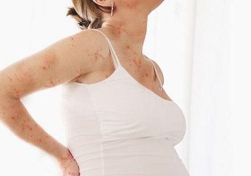 How does chickenpox affect the health of mother and fetus?