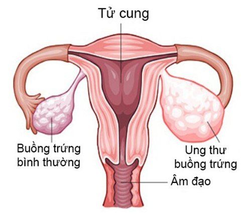 
Ung thư buồng trứng
