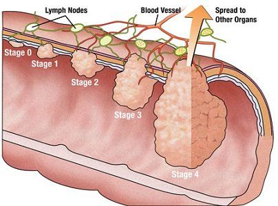 
Các giai đoạn phát triển của ung thư đại tràng
