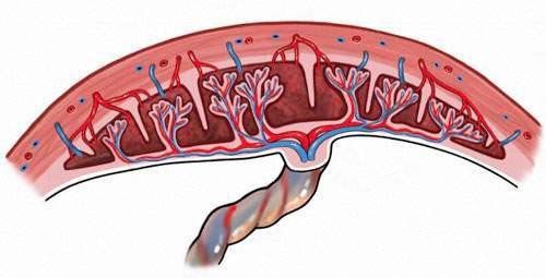 
When placenta accreta does not cause bleeding
