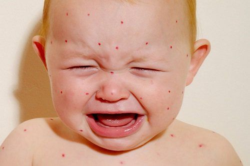 What is measles?