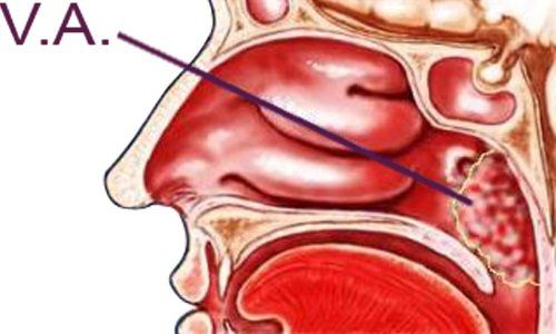 
Nạo VA cho trẻ được thực hiện khi tình trạng viêm VA ở trẻ diễn ra nhiều lần
