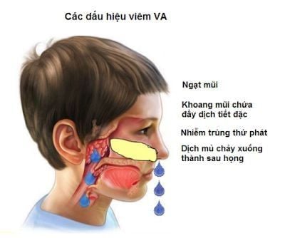 
Các dấu hiệu của viêm VA cấp tính
